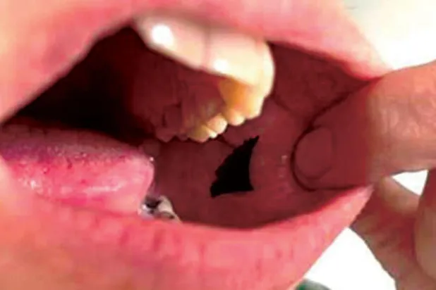 تجربة واعدة لتوصيل الإنسولين بلاصق فموي