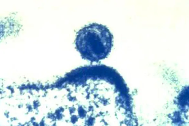 اكتشاف سلالة جديدة من فيروس نقص المناعة البشرية في هولندا