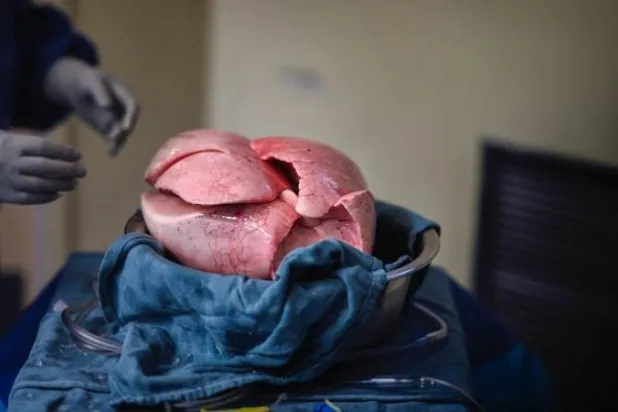 اختراق قد يسمح بزراعة الرئة رغم عدم تطابق فصيلة الدم بين شخصين