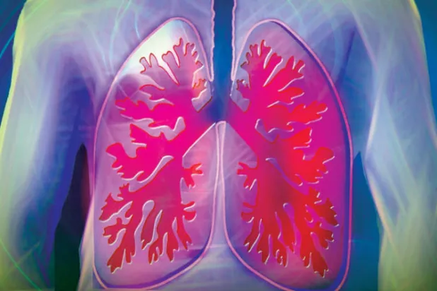اكتشاف يُبشر بعلاج أحد سرطانات الرئة