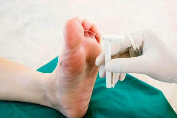 «الديرماسين»... تقنية حديثة لعلاج التقرحات والقدم السكري