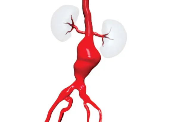 مخاطر تمدد الأوعية الدموية في البطن