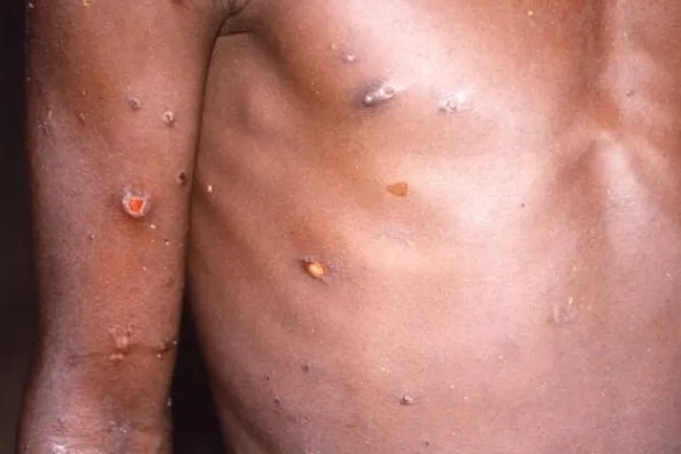 ادامه شیوع جهانی «آبله میمون»