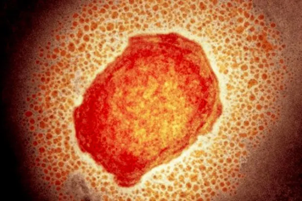 الإمارات تسجل أول إصابة بـ«جدري القرود»