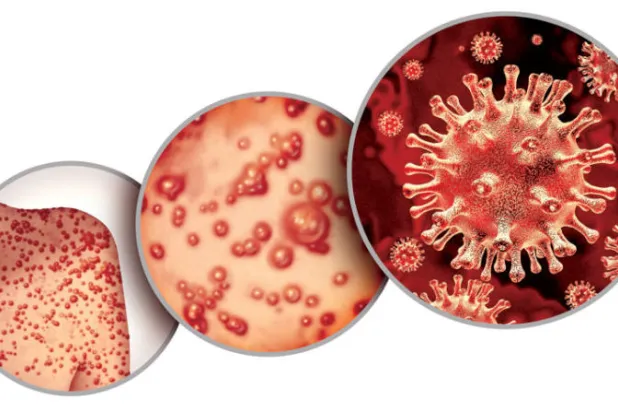 {جدري القردة}... مرض فيروسي ينتشر عالمياً