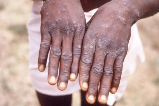 كيف بدأ التفشي الحالي لـ«جدري القردة»؟ أبرز الأسئلة التي يبحث العلماء الإجابة عنها (أ.ف.ب)