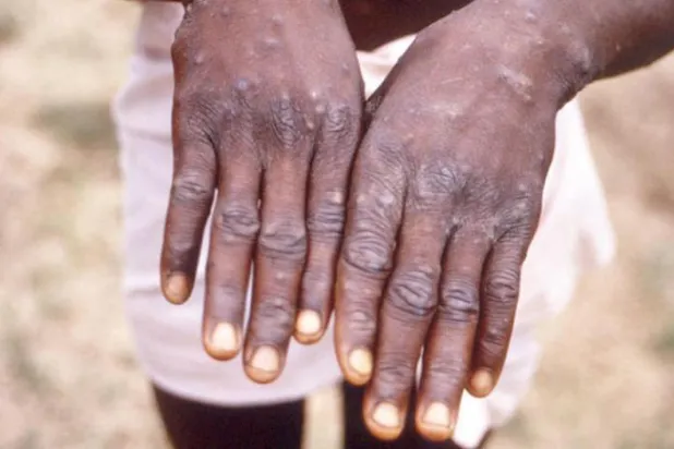 ‘Şu anki maymun çiçeği salgını nasıl başladı?’, bilim insanlarının cevabını en fazla merak ettiği soruların başında yer alıyor. (AFP)