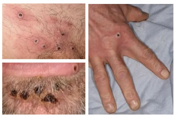 مرض جدري القردة انتشر في أفريقيا منذ سنوات (أ.ف.ب)