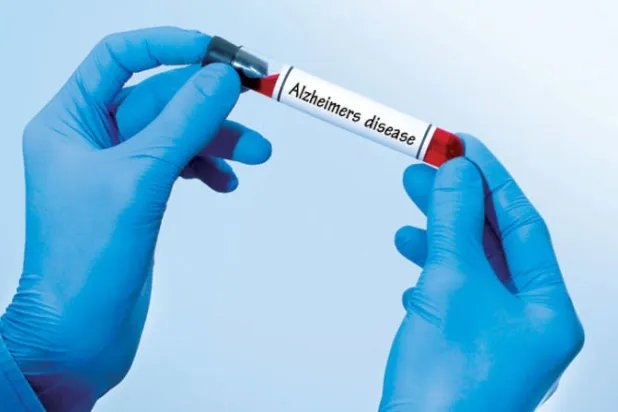 هل تساعد تحاليل الدم في تشخيص مرض ألزهايمر؟