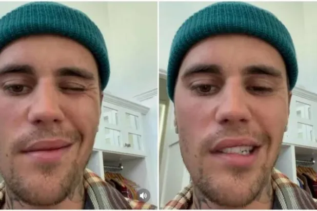 جاستن بيبر أفاد في مقطع فيديو  نشره في يونيو (حزيران) المنصرم بأنه يعاني من متلازمة «رامسي-هانت» (إنستغرام)