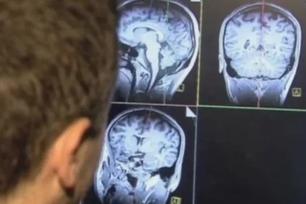 المصابون بورم دماغي قد يصبحون أكثر انسحاباً أو ارتباكاً بشكل مطّرد على مدى بضعة أشهر (رويترز)