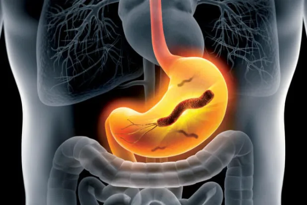 الأسبرين وجرثومة المعدة... علاقة معقدة في التسبب بقروحها