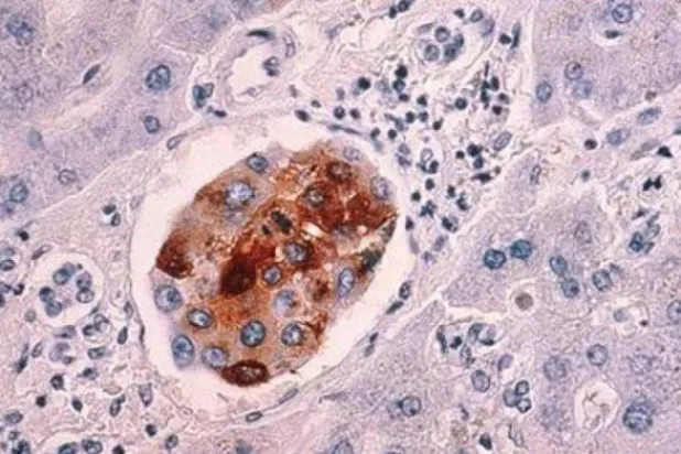 خلايا سرطانية (رويترز)
