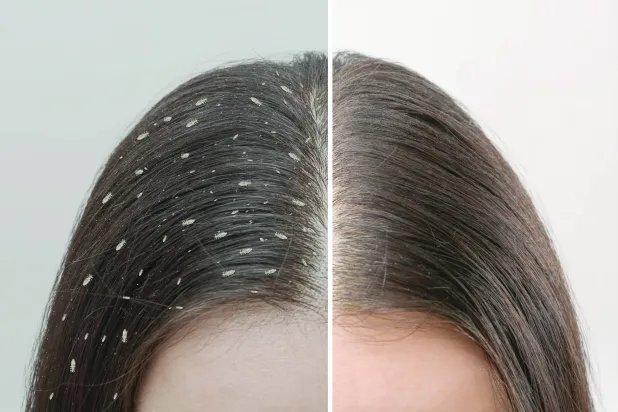 قمل الرأس يساعد على كشف تاريخ الهجرات البشرية