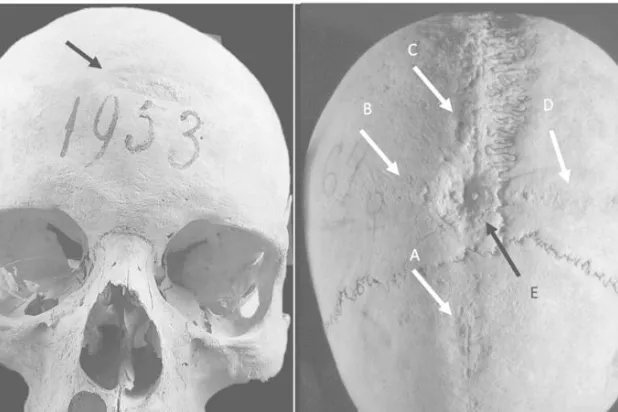 قد تكون عملية جراحية... اكتشاف ثقبين بجمجمة امرأة تعود لـ1300 عام