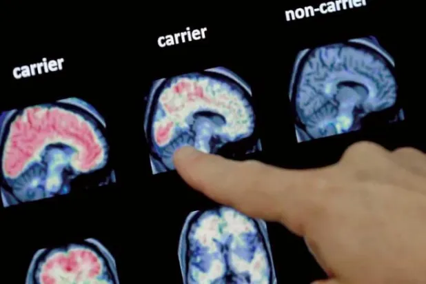 اكتشاف جزيء جديد لعلاج مرض ألزهايمر