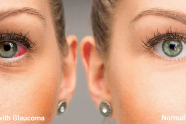 علاج جيني «محتمَل» لـ«الغلوكوما»