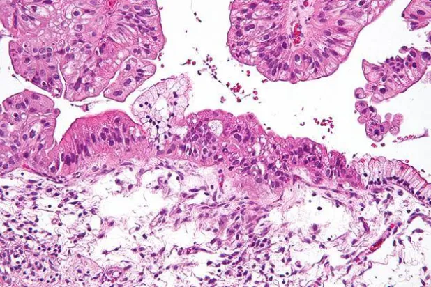 صورة مجهرية للأورام في المبيض (معهد جورجيا للتكنولوجيا)