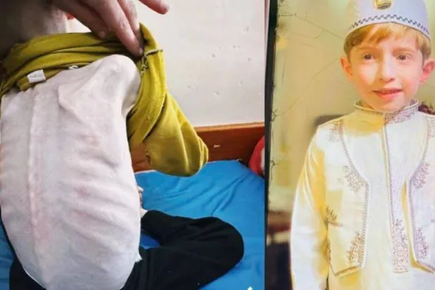 على اليمين صورة للطفل فادي الزنط قبل الحرب واليسار صورة له أمس في مستشفى كمال عدوان شمال غزة (متداولة)