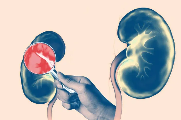 الدواء يمنح من يعانون من مرحلة مبكرة من مرض الكلى الأمل (غيتي)