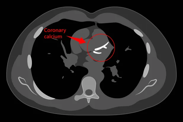 فحص الكالسيوم في الشريان التاجي