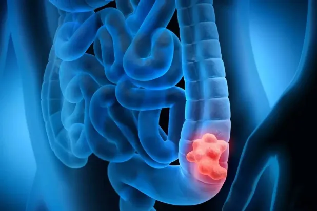 معدلات الإصابة بسرطان القولون والمستقيم ترتفع بسرعة بين الأشخاص في مرحلة العشرينات والثلاثينات والأربعينات من العمر (متداولة)