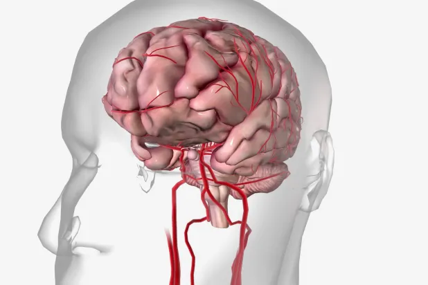 المشكلة الكبرى للسكتات الدماغية الصغيرة