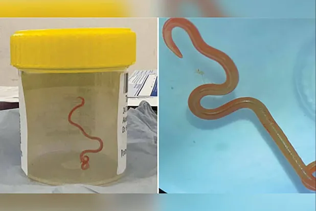 دودة طفيلية حيّة عُثر عليها في دماغ أسترالية للمرّة الأولى في العالم عام 2023 (رويترز)