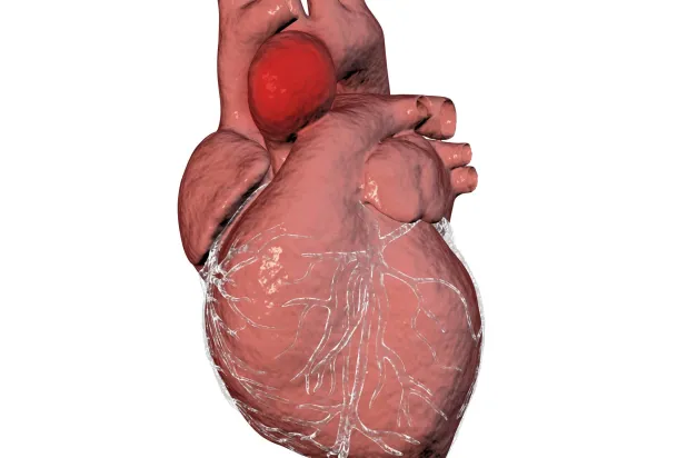 أم الدم في الأبهر الصاعد