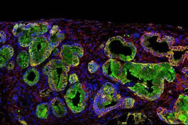 خلايا لأورام البنكرياس بعد معالجتها تحت الميكروسكوب (برونو ساينز)