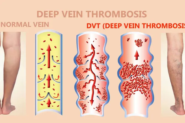 الاوردة العميقة الطبيعية (الى اليسار) والاوردة المصابة بالجلطات