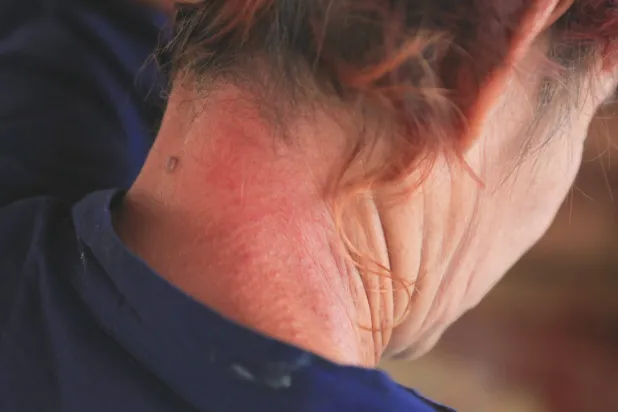 تطورات حديثة في علاج مرض تصلّب الجلد