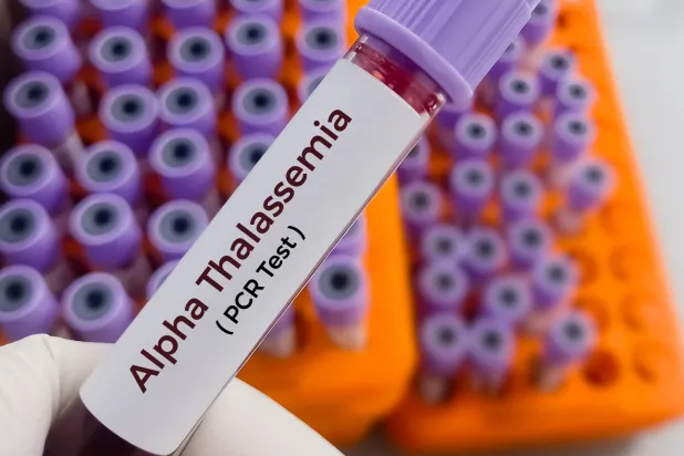 نقل الجينات لعلاج اضطراب «الثلاسيميا ألفا»