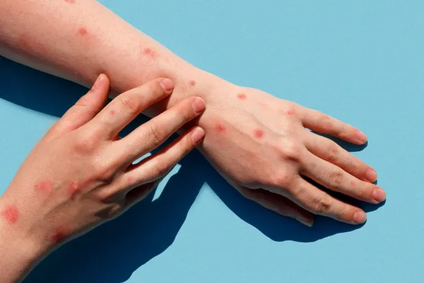 فيروس جدري القردة... «الأخطر» حتى الآن