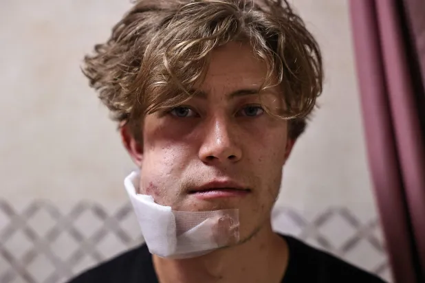 أحد أعضاء مجموعة المتطوعين الأجانب يتلقى العلاج بمستشفى رفيديا بنابلس بعد أن تعرضوا لهجوم مع الفلسطينيين الذين كانوا يساعدونهم في زراعة أراضيهم من قِبل المستوطنين الإسرائيليين بقرية قصرة بالضفة الغربية المحتلة (أ.ف.ب)