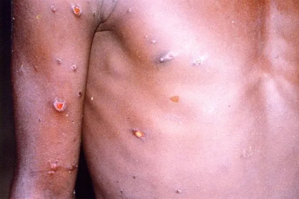 التوجيهات الصحية الرسمية تشير إلى أنه لا يمكن للأشخاص نقل عدوى جدري القردة إلا بعد ظهور الأعراض عليهم (رويترز)