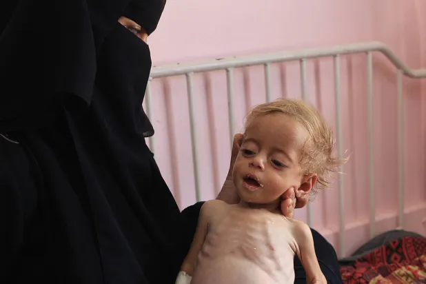 طفل يعاني سوء تغذية في مستشفى «ناصر» بخان يونس يوم 10 يوليو 2024 (أ.ف.ب)
