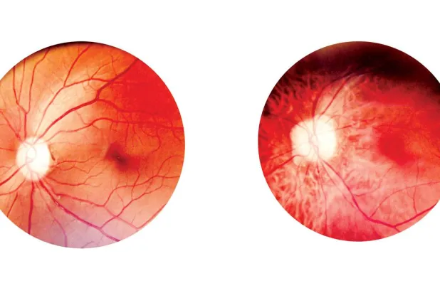 «اعتلال الشبكية السكري»... مسؤول عن 2.6 % من حالات العمى العالمية