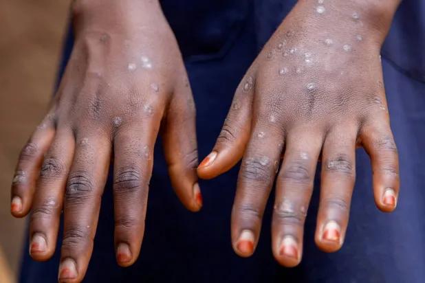 تظهر العلامات على يد طفلة بعد تعافيها من جدري القردة (رويترز)