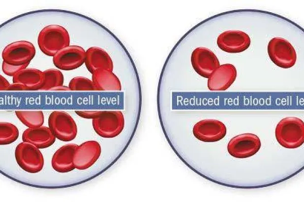 تدني مستوى الخلايا الحمراء في الدم (إلى اليمين) مقابل مستواها السليم
