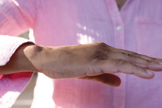 رعشة اليدين: 7 نقاط حول أنواعها وأسبابها