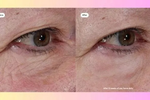 نتائج مثيرة للإعجاب قبل وبعد (شركة «تريني لندن»)