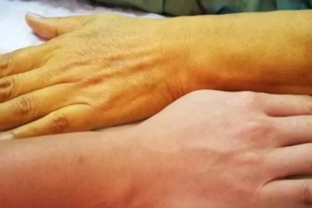 Sağlıklı bir kişi ile viral hepatite yakalanmış bir kişi arasındaki cilt rengi farkını gösteren görüntü (El-Merkeziyye)