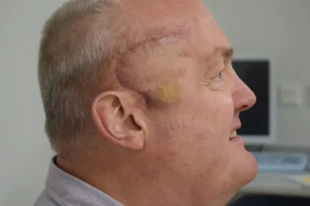 صورة نشرها فريق الدراسة لبول ريد المريض البريطاني الذي خضع للجراحة