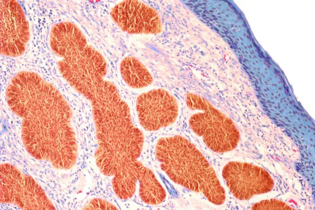 الصورة لحالة من سرطان الخلايا القاعدية... أحد أنواع سرطان الجلد