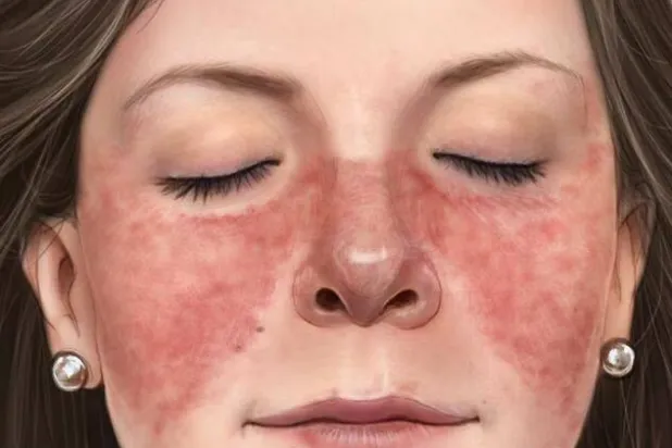 قد يعاني أحد المرضى آفاتٍ في الوجه، تشبه لدغات الذئب 