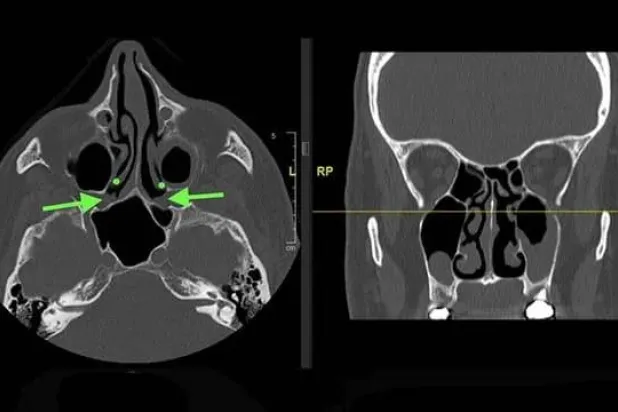 تقنيات جديدة لعلاج التهاب الأنف المزمن