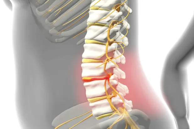  41 منطقة جديدة من الجينوم تعمل على تعديل خطر الإصابة بالانزلاق الغضروفي (غيتي)