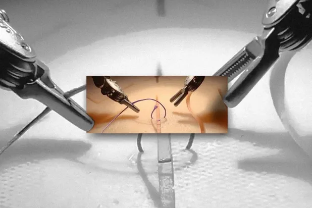«جراح آلي» بذكاء اصطناعي دُرّب على مشاهدة فيديوهات طبية