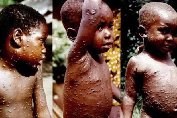 أطفال مصابون بجدري القرود في الكونغو عام 1970 (منظمة الصحة العالمية)